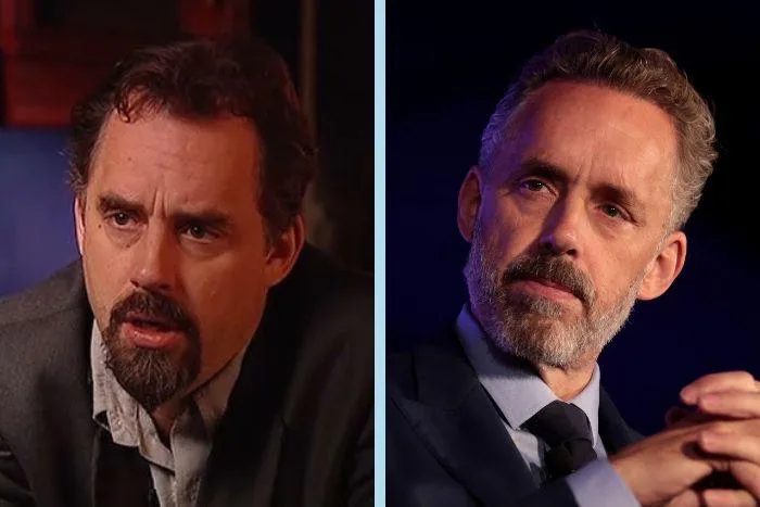 jordan peterson hair transplant