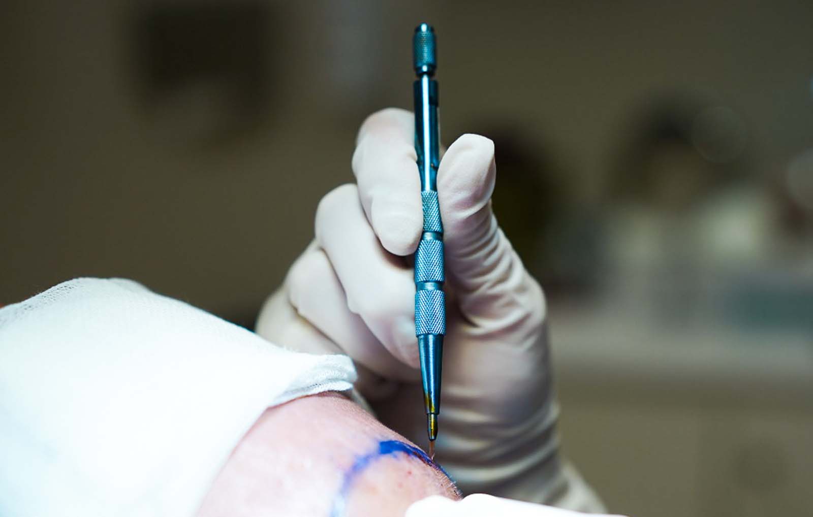 sapphire fue hair transplant operation