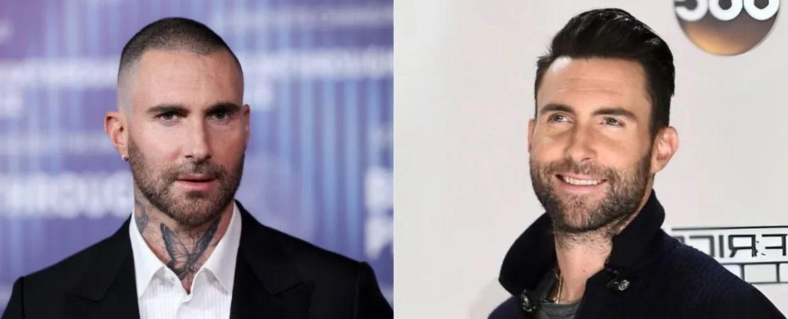 Adam Levine Hair Transplant