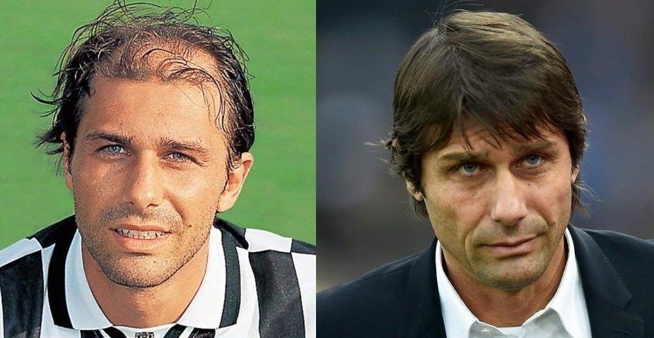 Celebrity Hair Transplants: 45 Transformations & Success Stories 5 Antonio Conte hair transplant