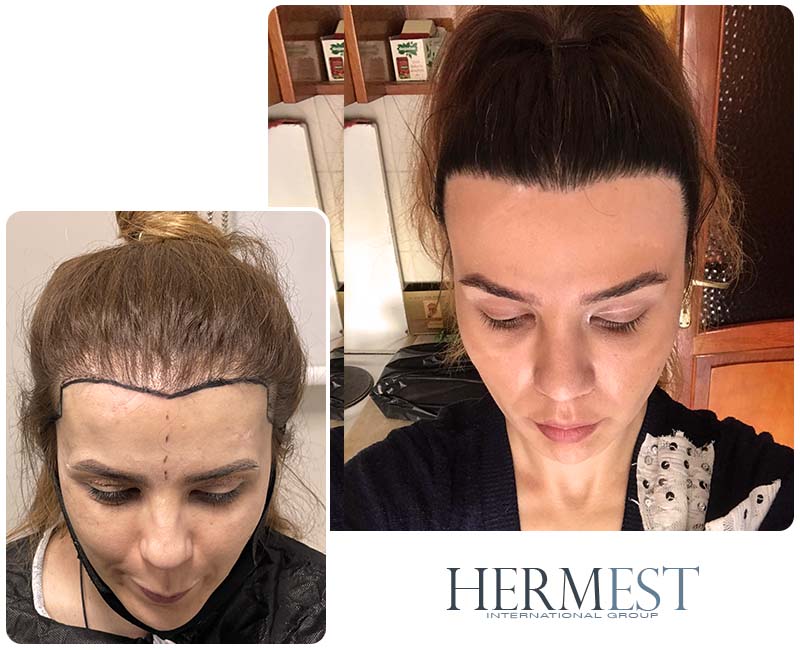 Before After Female Hair Transplant