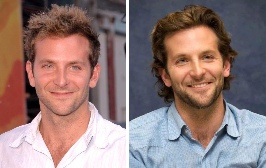 Celebrity Hair Transplants: 45 Transformations & Success Stories 8 Bradley Cooper hairline