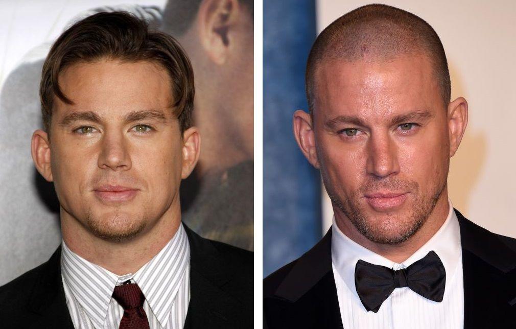 Celebrity Hair Transplants: 45 Transformations & Success Stories 10 Channing Tatum hair transplant