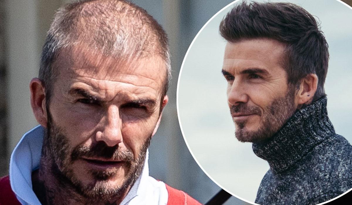 Celebrity Hair Transplants: 45 Transformations & Success Stories 11 David Beckham hair transplant