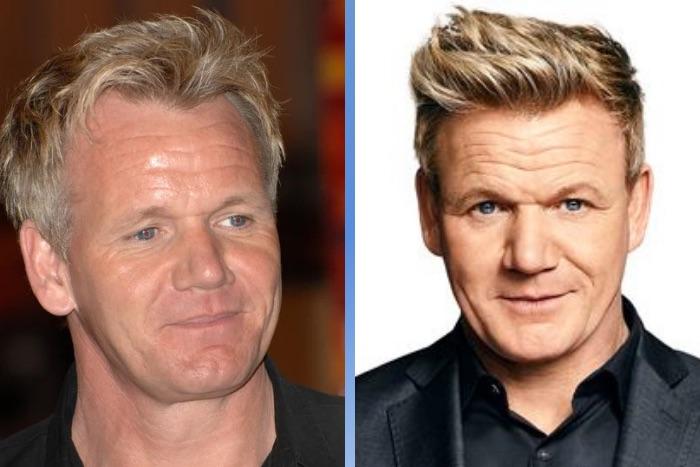 Celebrity Hair Transplants: 45 Transformations & Success Stories 18 Gordon Ramsay