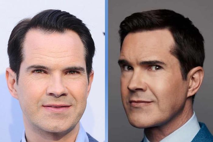 Celebrity Hair Transplants: 45 Transformations & Success Stories 22 Jimmy Carr