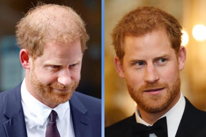 Celebrity Hair Transplants: 45 Transformations & Success Stories 36 Prince Harry