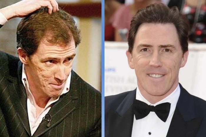 Celebrity Hair Transplants: 45 Transformations & Success Stories 37 Rob Brydon