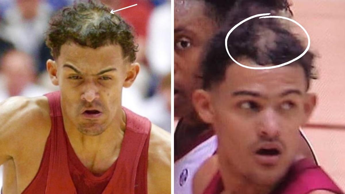 Trae Young hair transplant 2 Trae Young hair loss