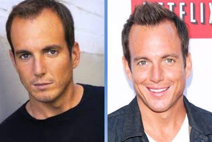 Celebrity Hair Transplants: 45 Transformations & Success Stories 45 Will Arnett