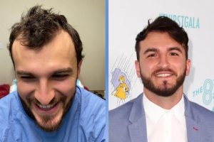 Celebrity Hair Transplants: 45 Transformations & Success Stories