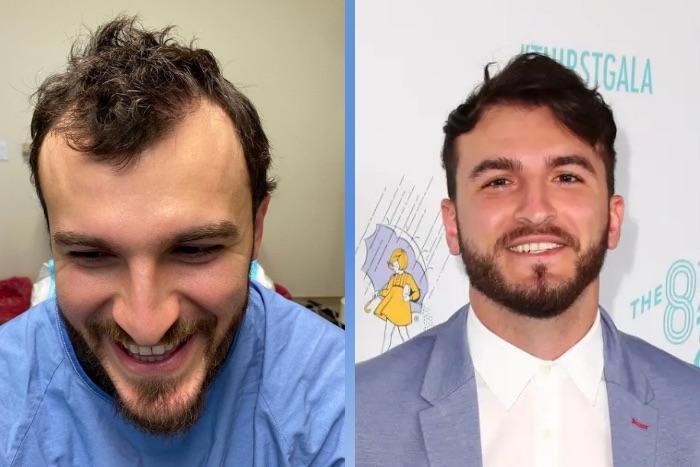 Celebrity Hair Transplants: 45 Transformations & Success Stories 46 Zane Hijazi