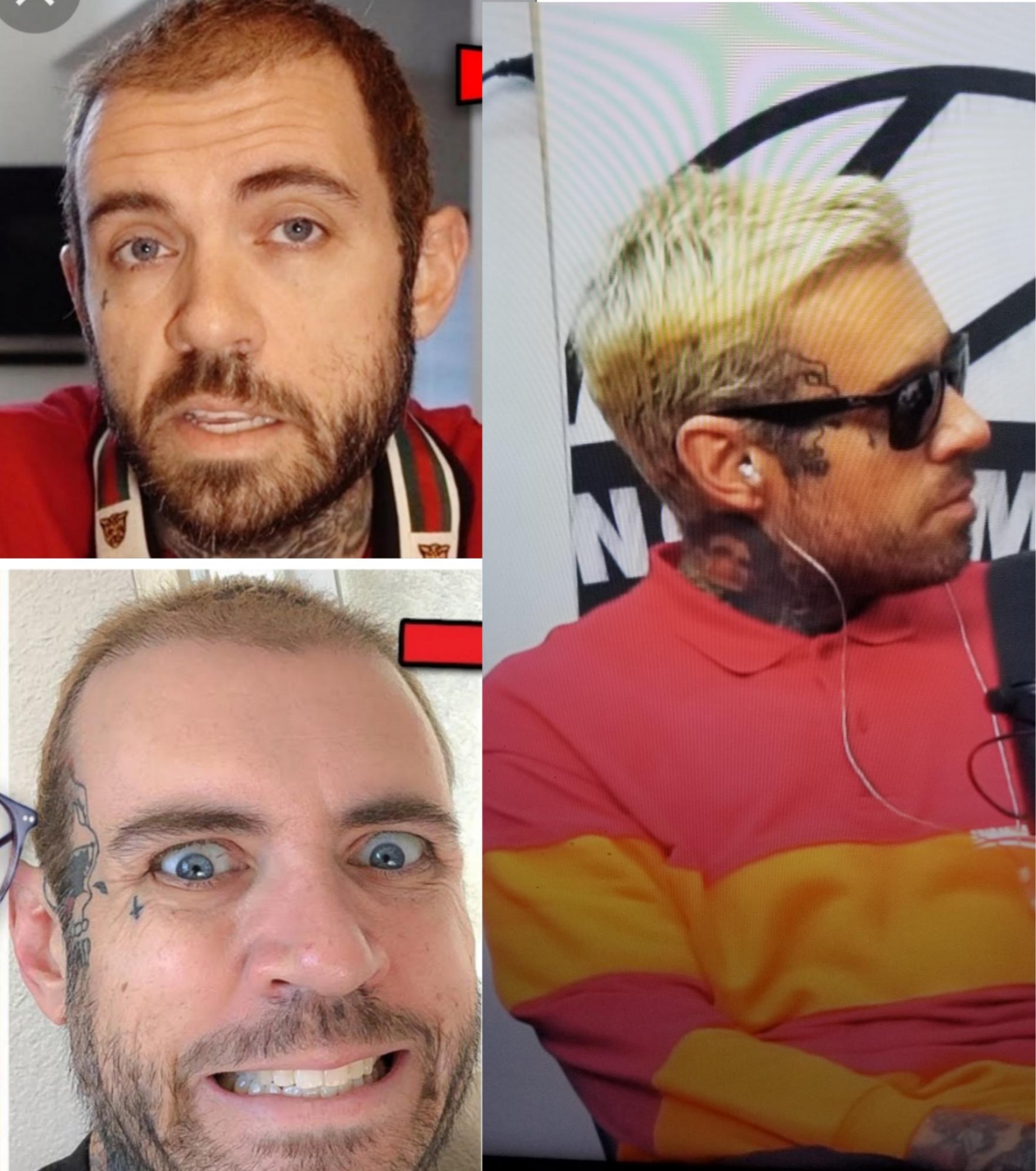 Celebrity Hair Transplants: 45 Transformations & Success Stories 3 adam22 hair transplant