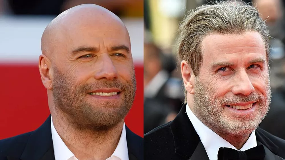 john travolta hair transplant