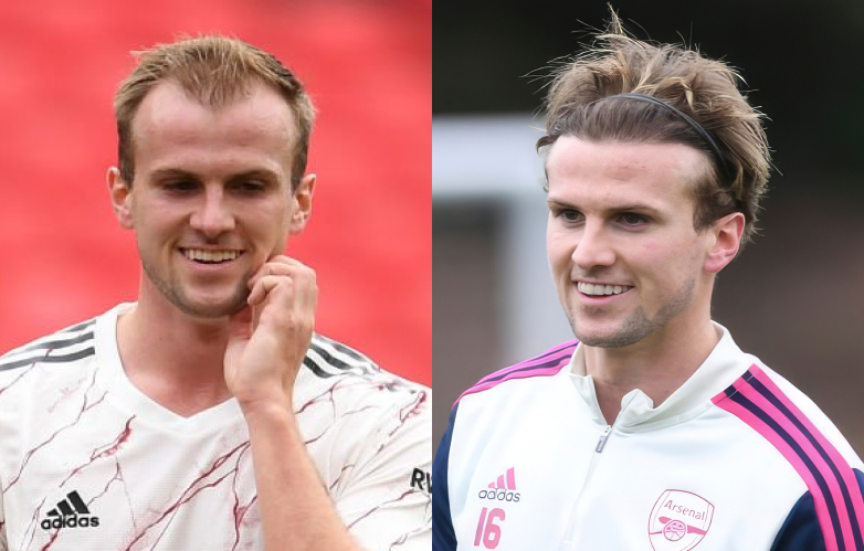 Rob Holding Hair Transplant 2 rob holding hair transplant before after