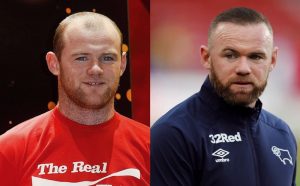 Wayne Rooney Hair Transplant: Cost, Technique & Results 2 wayne rooney hair transplant