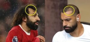 mo salah hair transplant review