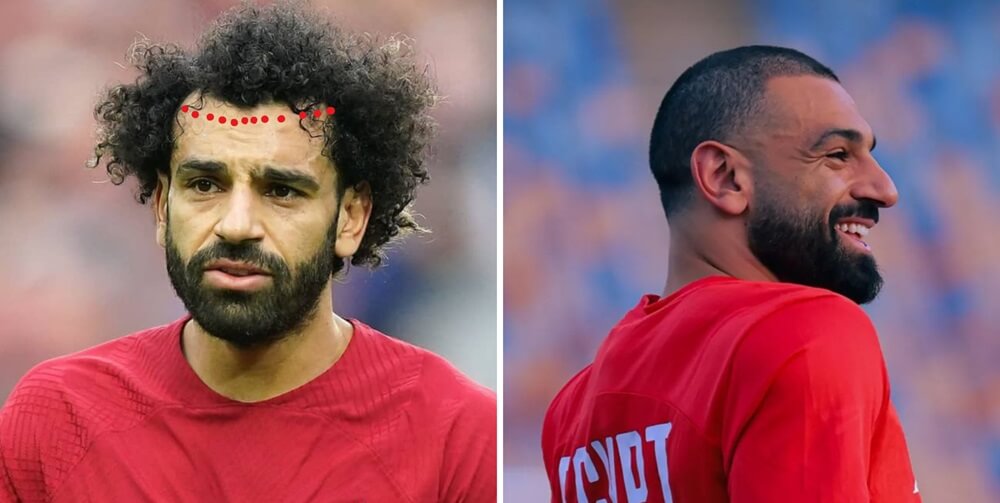 mo-salah-hair-transplant-truth-costs-before-after-photos