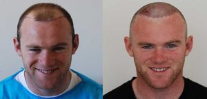 Wayne Rooney Hair Transplant: Cost, Technique & Results 4 wayne rooney hair journey