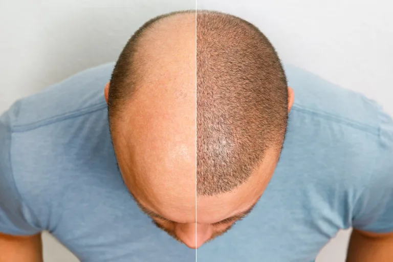 hair graft cost