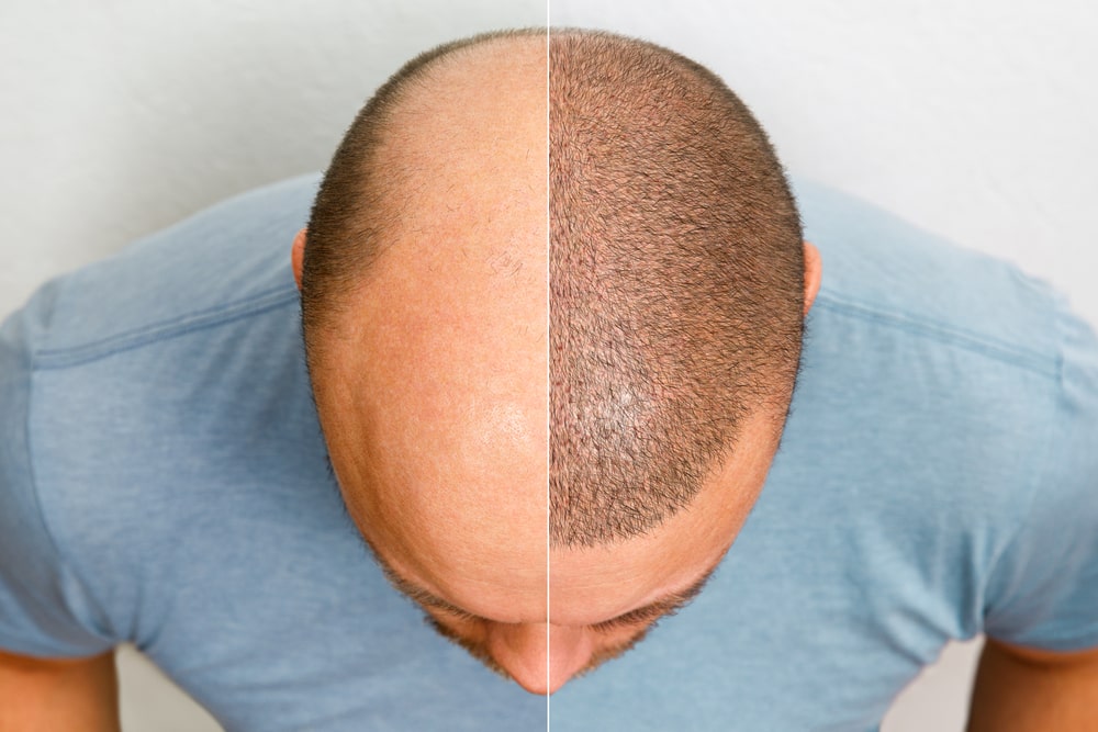 hair graft cost