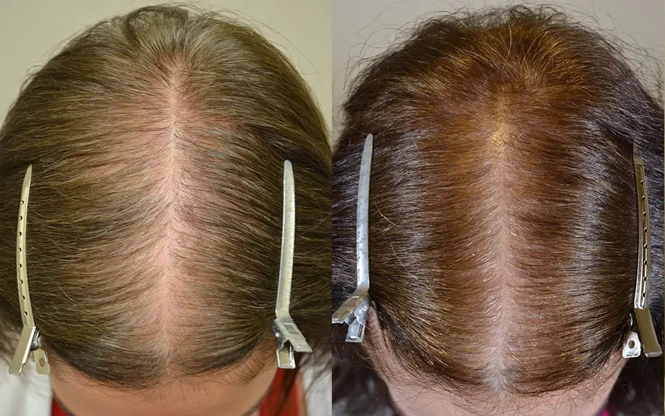 can spironolactone cause hair loss