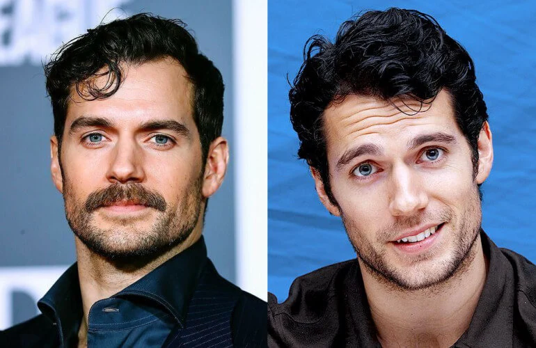 henry-cavill-hair-transplant