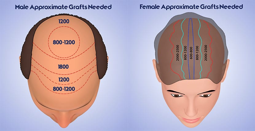 How Many Hair Grafts Do I Need? Accurate Graft Planning Guide (2026) 2 how many hair grafts do i need