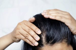 Causes of Hair Loss During Perimenopause