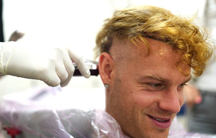 Geheimratsecken mit 20 – Ursachen, Anzeichen und Behandlung 12 Geheimratsecken mit 20