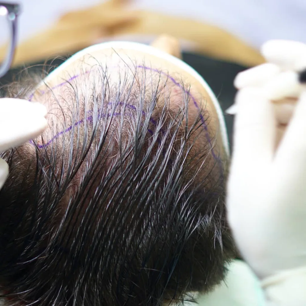 Mann vor und nach dem Eingriff – Ergebnis zeigt deutliche Haarverdichtung, Beispiel für eine Haartransplantation; ideal zur Veranschaulichung der Haartransplantation Dauer und Wirkung.
