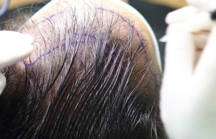 Haartransplantation Dauer – Wie lange dauert der Eingriff? 8 Mann vor und nach dem Eingriff – Ergebnis zeigt deutliche Haarverdichtung, Beispiel für eine Haartransplantation; ideal zur Veranschaulichung der Haartransplantation Dauer und Wirkung.