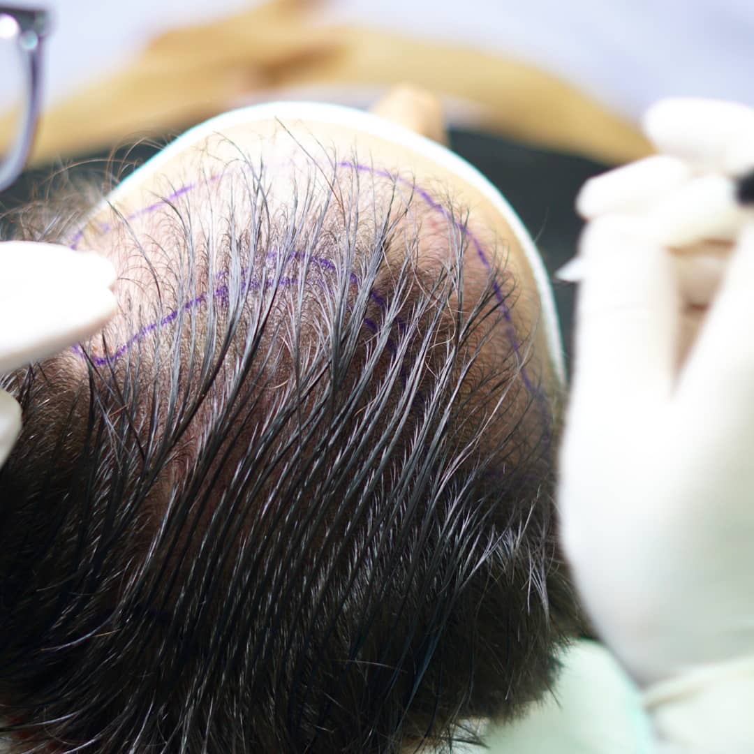Mann vor und nach dem Eingriff – Ergebnis zeigt deutliche Haarverdichtung, Beispiel für eine Haartransplantation; ideal zur Veranschaulichung der Haartransplantation Dauer und Wirkung.