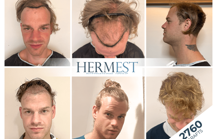 Haartransplantation Erfolgsquote – die Fakten im Überblick 2 Haartransplantation Erfolgsquote