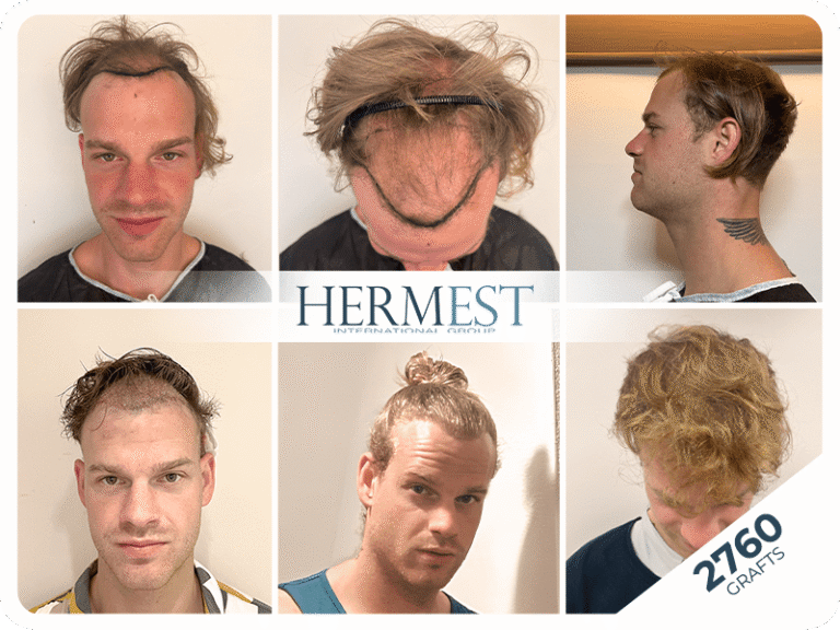 Haartransplantation Erfolgsquote