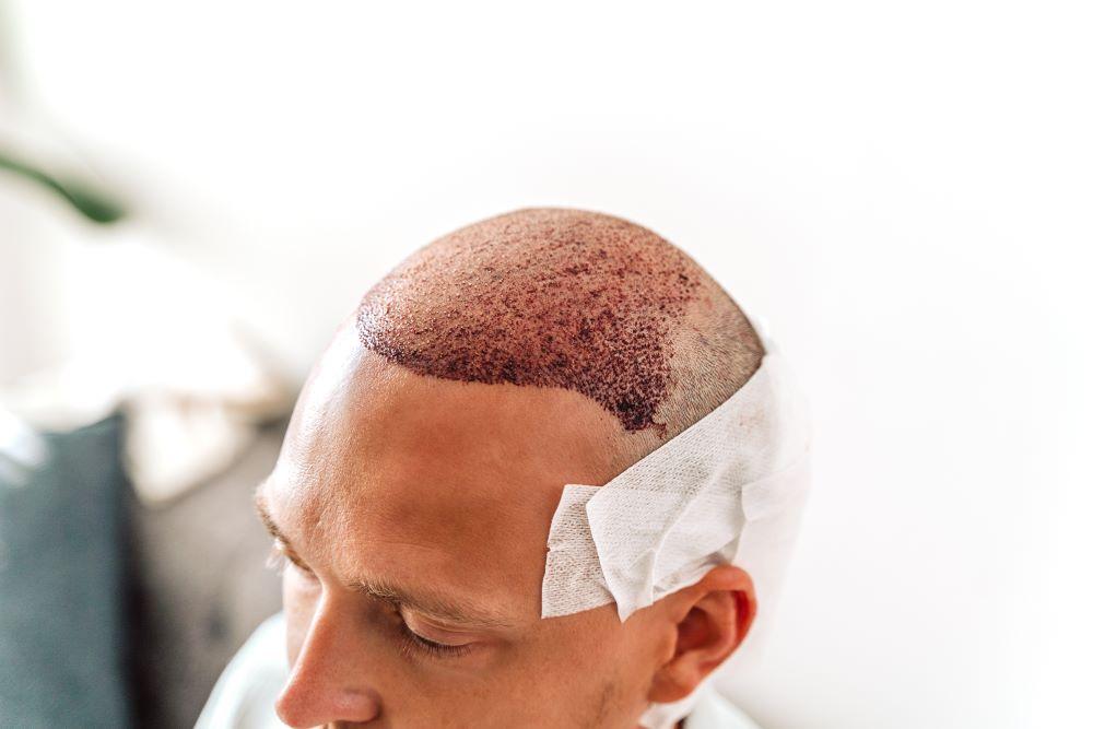 Haartransplantation Krusten