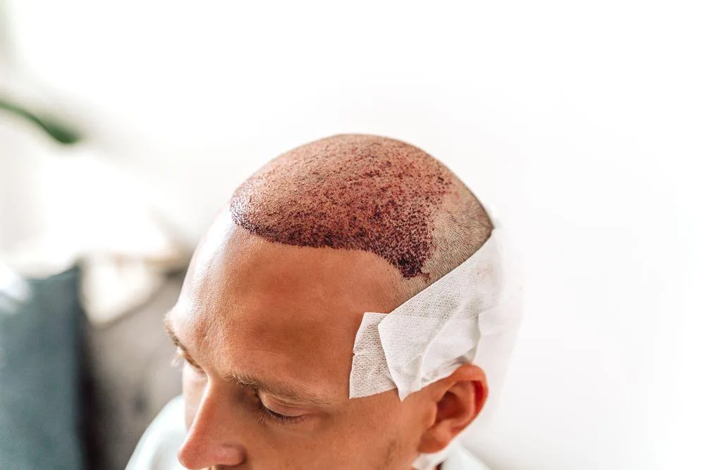 Haartransplantation Krusten