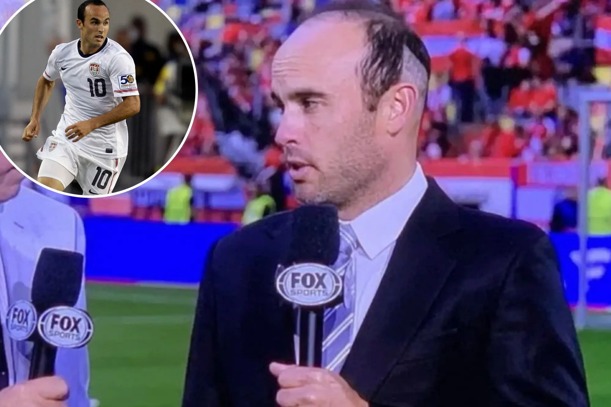 Landon Donovan Hair Transplant