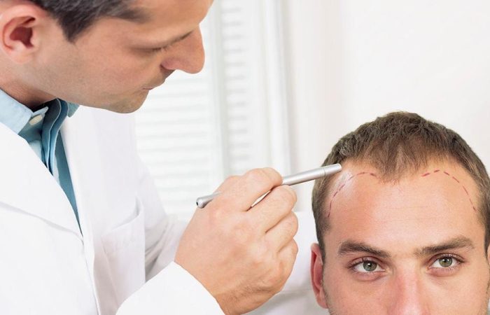 Patientenleitfaden 4 Patientenleitfaden - Haartransplantation