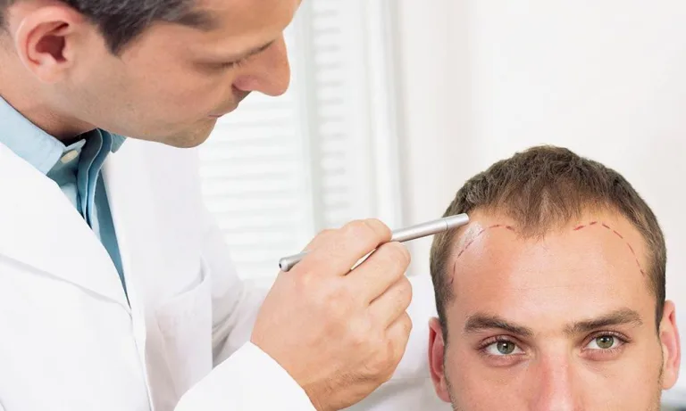 Patientenleitfaden - Haartransplantation