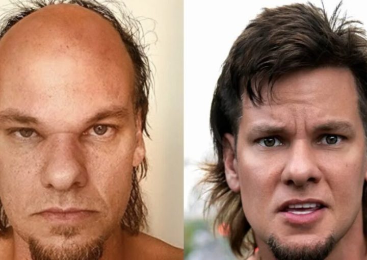 Theo Von Hair Transplant: Procedure, Results & Insights 1 Theo Von hair transplant