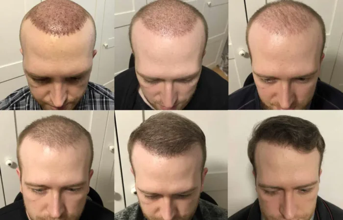 Bilder zum Verlauf des Haarwachstum nach einer Haartransplantation