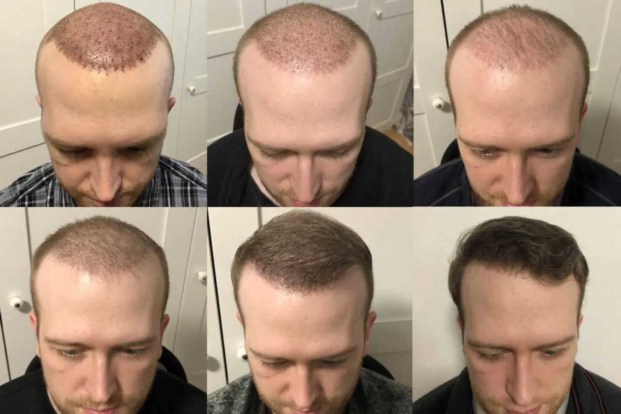 Bilder zum Verlauf des Haarwachstum nach einer Haartransplantation