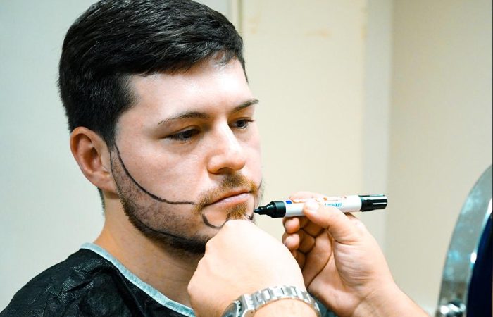 Long Hair Fue 48 beard hair tranplant in turkey