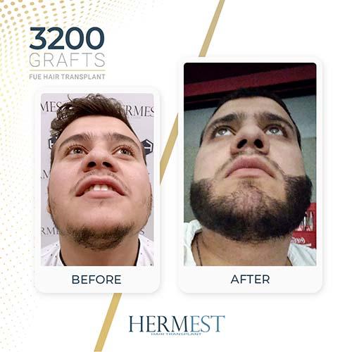 Beard Transplant Turkey 4 beard transplant turkey hermest hair clinic