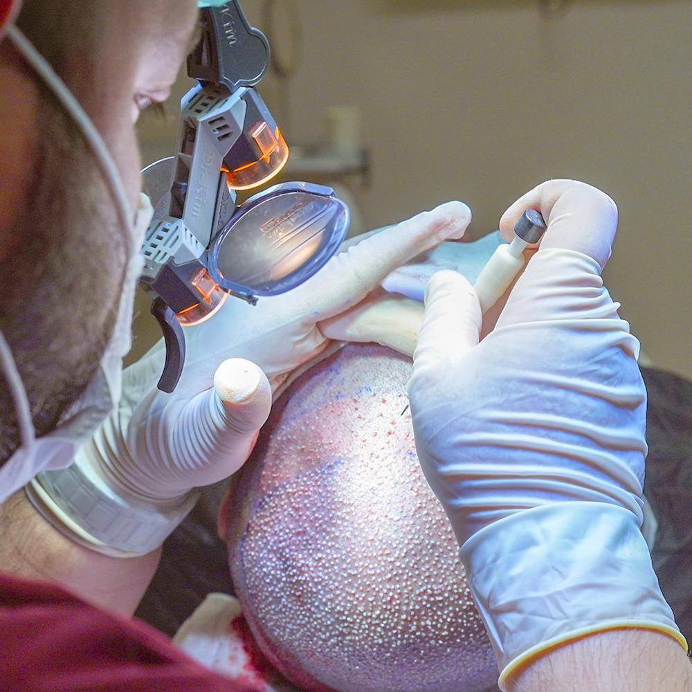 Best Hair Transplant Methods 6 dhi hairtransplant 1
