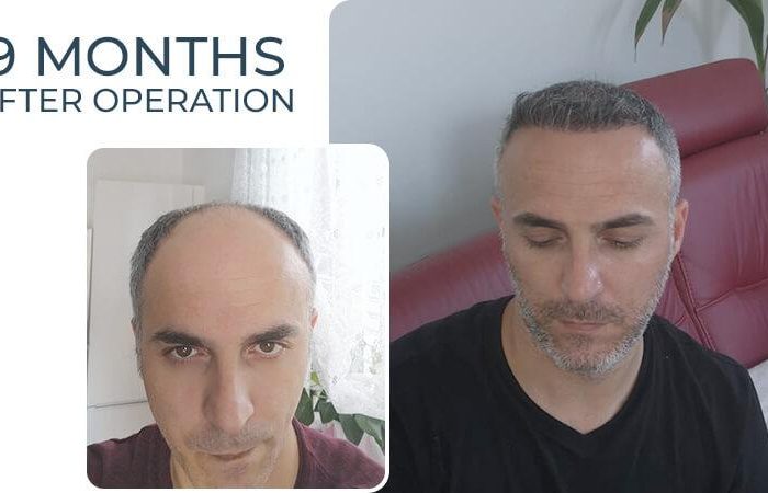 Taubheitsgefühl nach Haartransplantation: Wann verschwindet es? 5 Haartransplantation Türkei - Vorher Nachher - 9 Monate