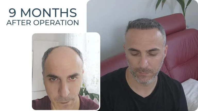 Haartransplantation Türkei - Vorher Nachher - 9 Monate