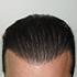 Unshaven Hair Transplant 9 hair transplant completed