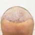 Unshaven Hair Transplant 8 hair transplant completion